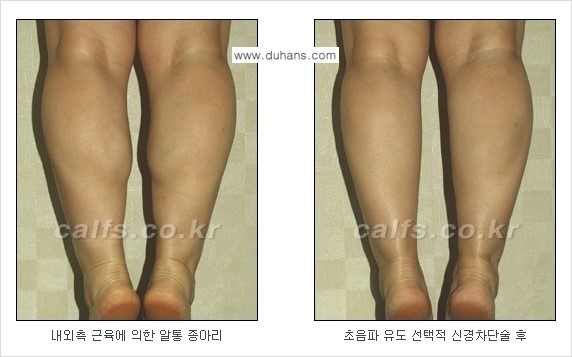 ​[두한성형외과와 날씬한 종아리 만들기!] - [간편하고 안전한 종아리 축소방법 ③] 관련 이미지 8