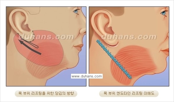 [두한성형외과 젊어지는 주름교정술] - [주름제거 시술방법 ②] 관련 이미지 7