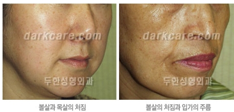 Duhan Plastic Surgery Combo Program - Dark Circles and Lifting image 3