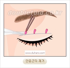 [두한성형외과 경쟁력 눈성형] - [자연스럽고 아름다운 눈매를 만드는 여러 가지 눈성형 방법] 관련 이미지 7