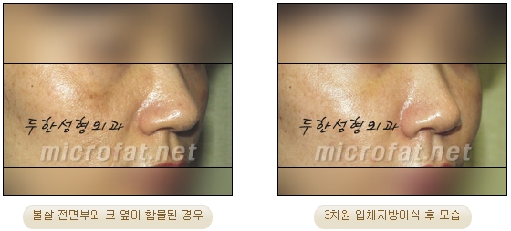 [Duhan Plastic Surgery Face Autologous Fat Grafting] - [Noble Surgery and Indian Band Fat Grafting] image 18
