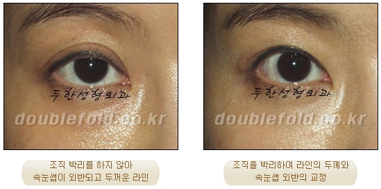 [두한성형외과 쌍수] - [재수술 실패의 원인, 재수술의 성공 요건] 관련 이미지 5