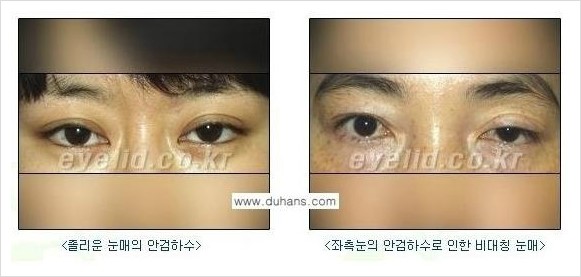 [두한성형외과 경쟁력 눈성형] - [안검하수(졸리운 눈매)의 종류와 교정 방법 안내] 관련 이미지 2