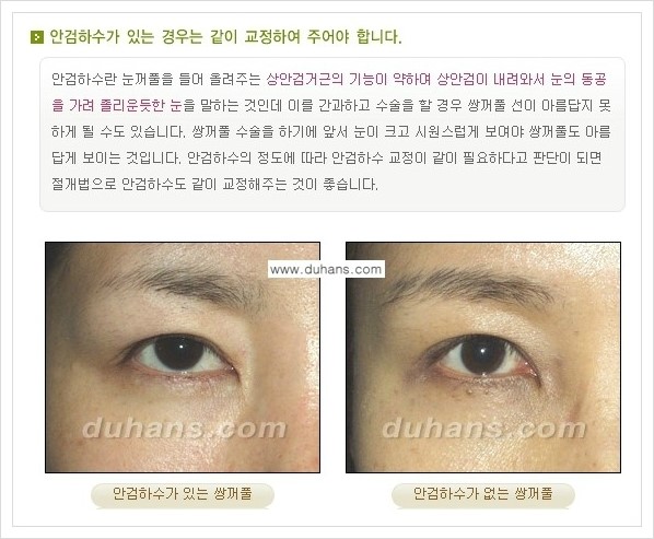 ​[두한성형외과 경쟁력 눈성형] - [자연스럽고 아름다운 쌍꺼풀의 기준] 관련 이미지 6