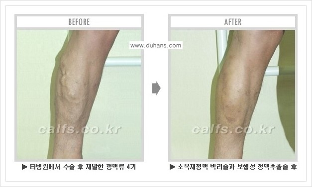[두한성형외과 경쟁력 멀티종아리성형] - [하지정맥류 치료 안내] 관련 이미지 8