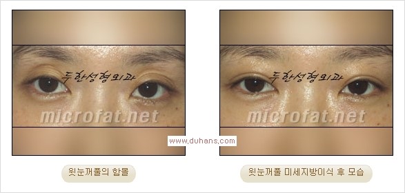 [두한성형외과 Dr. 컬럼] - [눈꺼풀의 지방이식] 관련 이미지 13