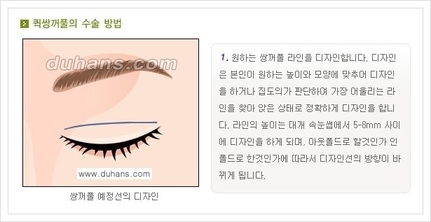 [두한성형외과 경쟁력 눈성형] - [퀵쌍꺼풀 안내] 관련 이미지 2