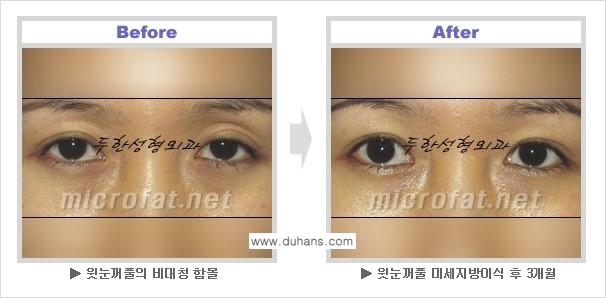 [두한성형외과 NO.1 눈성형] - [눈꺼풀 지방이식 관련 흔한 질문과 답변] 관련 이미지 4