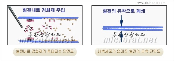 [두한성형외과 경쟁력 정맥류 치료] - [손, 손등, 손목혈관확장증, 팔혈관확장증에 질문과 답변] 관련 이미지 6