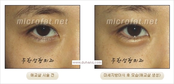 [두한성형외과 경쟁력 눈밑성형] - [타 병원 필러 애교살 시술 부작용을 미세지방이식으로 교정] 관련 이미지 32