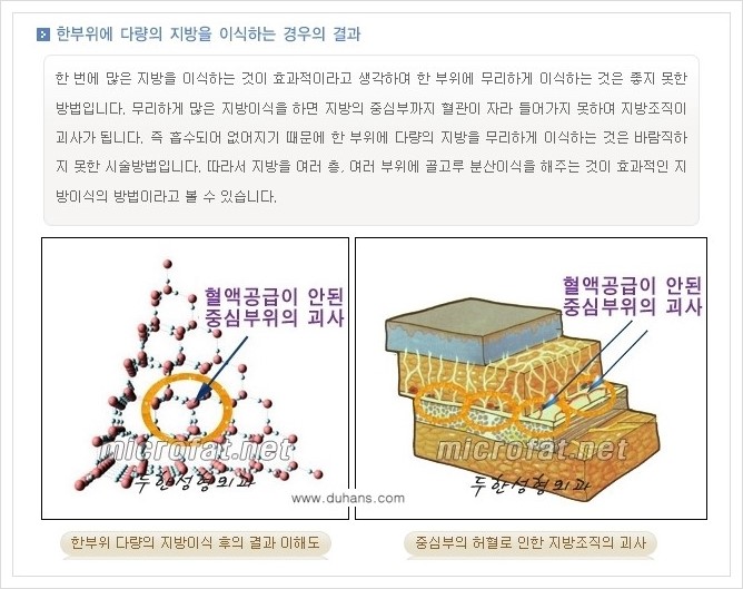 [두한성형외과 경쟁력 미세지방이식] - [3차원 입체 미세지방이식 안내] 관련 이미지 2