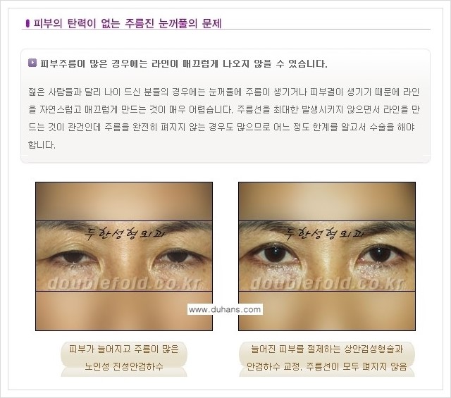 [두한성형외과 경쟁력 쌍꺼풀 재수술, 극한 재수술] - [재수술에서 극복해야 할 극한의 상황과 문제들 안내] 관련 이미지 7