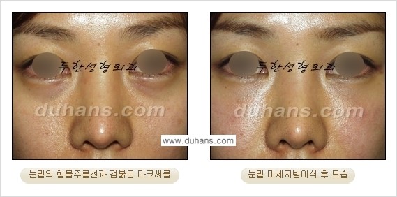 [두한성형외과 상큼하고 환한 눈매완성] - [눈밑 미세지방이식 ①] 관련 이미지 11