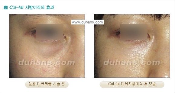 [두한성형외과 경쟁력 미세지방이식] - [탄력있는 피부와 윤곽을 만들어주는 Col-fat 지방이식] 관련 이미지 7