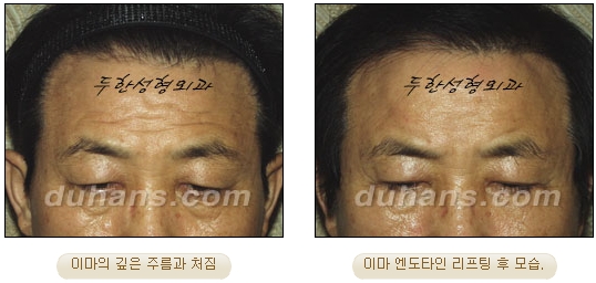 [두한성형외과 주름개선] - [주름교정 방법] 관련 이미지 17
