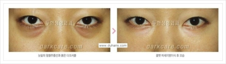[두한성형외과 경쟁력 다크써클 교정] - [다양한 다크써클 증상 안내 2.] 관련 이미지 7