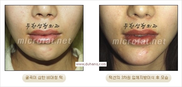 [두한성형외과 경쟁력 미세지방이식] - [부드럽고 아름다운 얼굴윤곽선 턱(하악부) 미세지방이식 안내] 관련 이미지 20
