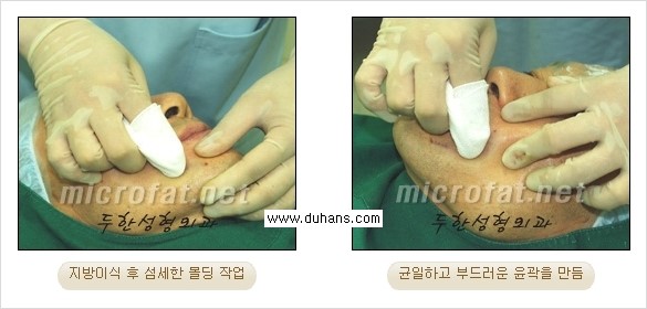 [두한성형외과 경쟁력 미세지방이식] - [Dr. 컬럼 "미세지방이식 클리닉의 특징과 자부심"] 관련 이미지 8