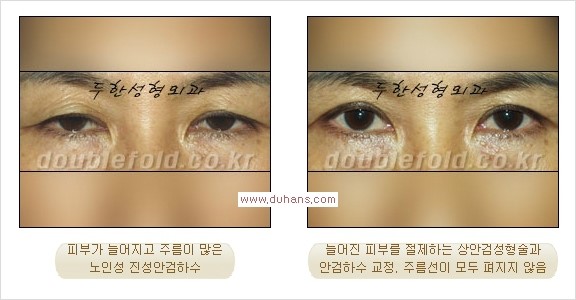 ⁠⁠[두한성형외과 경쟁력 쌍꺼풀 재수술] - [재수술 대상과 재수술의 문제점] 관련 이미지 16