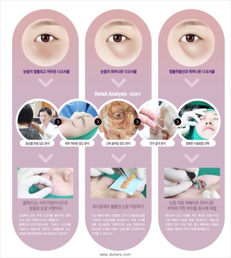​☞ [두한성형외과] - [다크써클 클리닉의 핵심 솔루션  5 STEP 을 소개합니다.]☜ 관련 이미지 5
