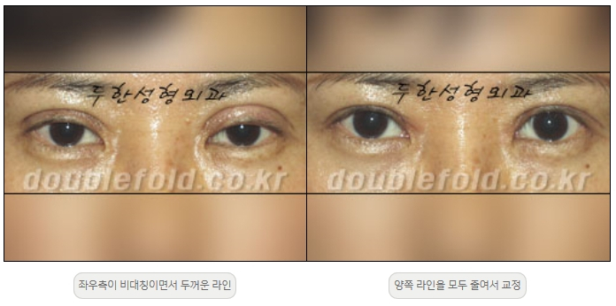 [두한성형외과 쌍커플재수술] - [비대칭 쌍커풀 라인] 관련 이미지 17