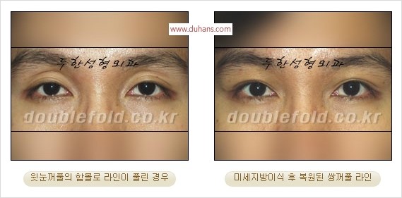 [두한성형외과 경쟁력 쌍꺼풀 재수술 리더] - [풀린 쌍꺼풀, 풀려버린 쌍꺼풀 재수술 방법 안내] 관련 이미지 4