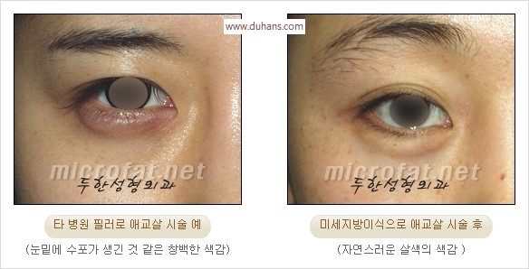 [두한성형외과 경쟁력 눈밑성형] - [타 병원 필러 애교살 시술 부작용을 미세지방이식으로 교정] 관련 이미지 2