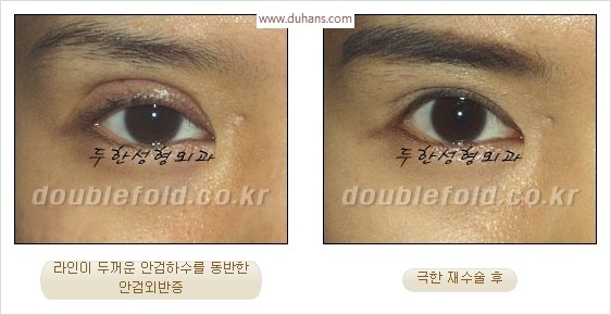 [두한성형외과 경쟁력 눈성형] - [극한 재수술, 함몰된 눈꺼풀 라인교정, 안검하수(졸리운 눈매)] 관련 이미지 24