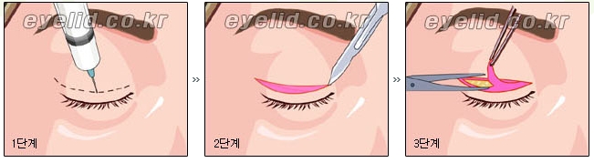 [두한성형외과 눈성형] - [쌍꺼풀수술의 절개법, 매몰법] 관련 이미지 2