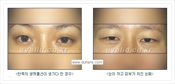 [두한성형외과 경쟁력 쌍꺼풀 재수술, 극한 재수술] - [쌍꺼풀 수술 관련 질문과 답변] 관련 이미지 2