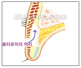 [Doohan Plastic Surgery Double Eyelid Revision Surgery] - [Double Eyelid Revision Surgery Process] image 20