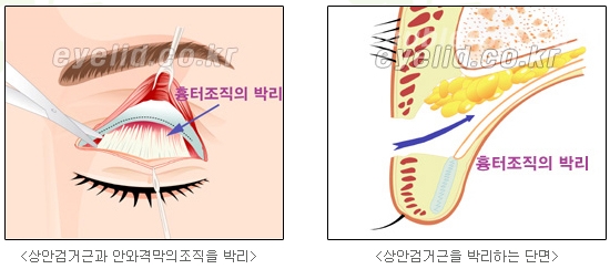 [Duhan Plastic Surgery Secondary Double Eyelid Surgery] - [Sleepy Eye Appearance, Asymmetrical Eye Appearance, Ptosis] image 7