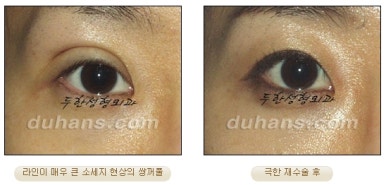 [Special Double Eyelid Revision Surgery at Duhan Plastic Surgery] - [Restorative Surgery for Damaged Double Eyelid Eye Shape] image 21