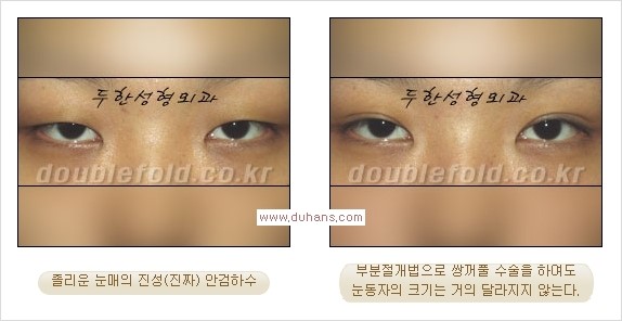 [두한성형외과 경쟁력 쌍꺼풀 재수술, 극한 눈재수술] - [안검하수(졸린 눈매)의 종류 안내] 관련 이미지 2