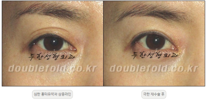 [Double Eyelid Surgery, Duhan Plastic Surgery] - [Extreme Revision Eye Surgery to Correct a Damaged Line] image 31