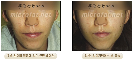 얼굴지방이식 두한성형외과 - 볼지방이식 관련 이미지 30