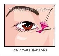 [두한성형외과 경쟁력 눈성형] - [흉터없는 몽고주름 제거술(앞트임) 관련 이미지 9