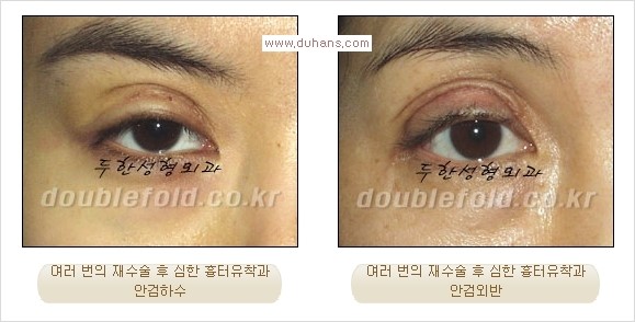 [두한성형외과 경쟁력 쌍꺼풀 재수술, 극한 재수술]- [쌍꺼풀 재수술의 성공 조건(Condition of successful reoperation) 관련 이미지 1