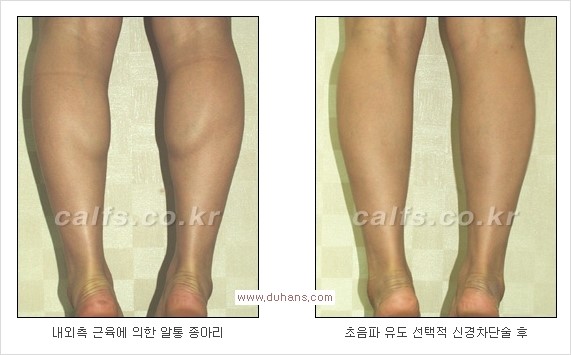 ⁠[두한성형외과 경쟁력 종아리성형] - [종아리퇴축술 - 비절개 초음파 유도 선택적 신경차단술 장비 안내] 관련 이미지 12