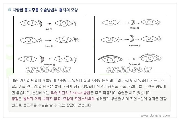 [두한성형외과 경쟁력 눈성형] - [몽고주름 제거수술, 앞트임 수술 안내] 관련 이미지 6