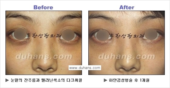 [두한성형외과의 상큼하고 환한 젊은 눈매완성] - [하안검 성형술 ②] 관련 이미지 21