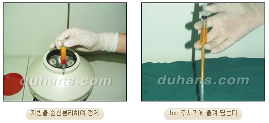 [Duhan Plastic Surgery Micro Fat Grafting] - [Upper Eyelids] image 5