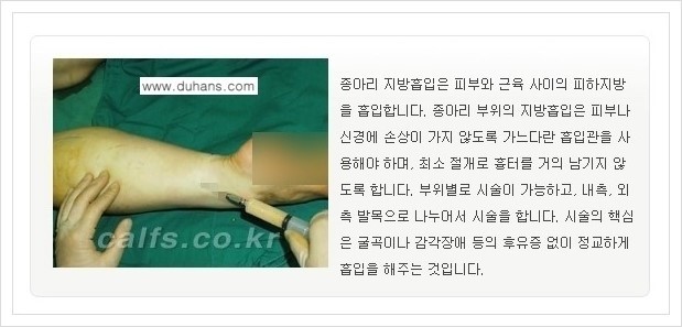 [두한성형외과 경쟁력 멀티종아리성형] - [두꺼운 종아리 정교한 미세흡입관 지방흡입술] 관련 이미지 5