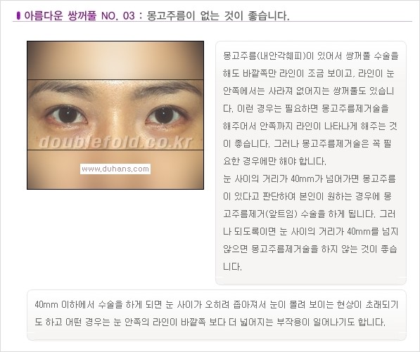 [두한성형외과 경쟁력 쌍꺼풀 재수술, 극한 재수술] - [Dr. 컬럼 - 아름다운 눈매의 조건이란?] 관련 이미지 4