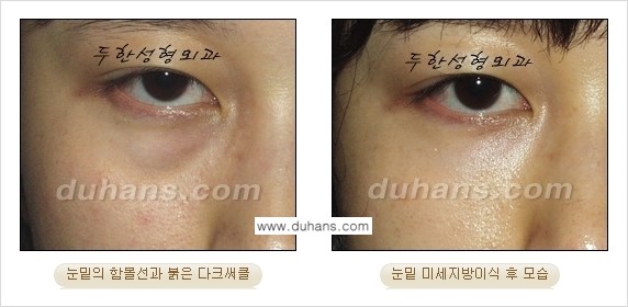 [두한성형외과 상큼하고 환한 눈매완성] - [눈밑 미세지방이식 ②] 관련 이미지 5