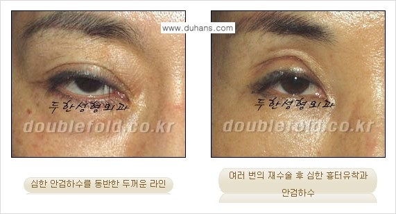 [두한성형외과 NO.1 경쟁력 눈성형] - [일반 쌍꺼풀 재수술과 극한 눈(쌍꺼풀) 재수술과의 차이점] 관련 이미지 2