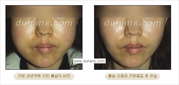 ​​​﻿[두한성형외과 경쟁력 간편지방흡입] - [볼살지방흡입, 턱선지방흡입 시술 과정의 안내] 관련 이미지 11
