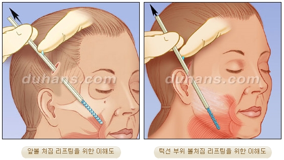 두한성형외과 안티에이징 리프팅 - 엔도타인 리프팅 관련 이미지 8