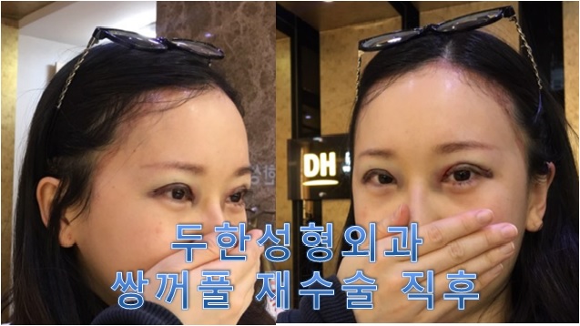 [두한성형외과]-쌍꺼풀 재수술 #눈재수술 #비대칭 눈교정 관련 이미지 2