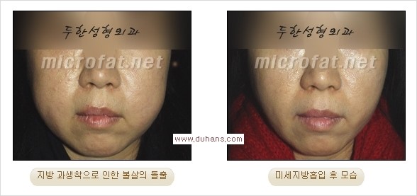 [두한성형외과 경쟁력 미세지방이식] - [타병원에서의 미세지방이식 이후 부작용 교정의 대상 안내] 관련 이미지 24